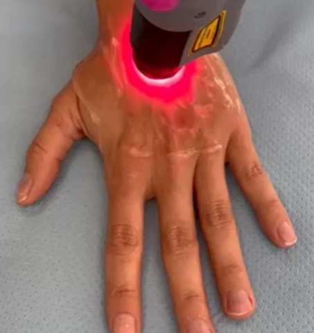 laser odmładzanie dłoni